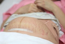 Sezeryan Sonrası Zayıflama