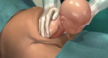 Sezeryan Kaçıncı Haftada Yapılır?